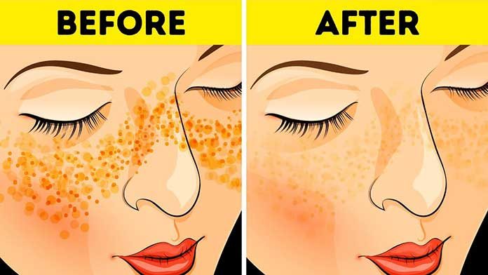 How To Get Rid Of Acne Scars Overnight